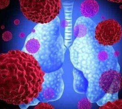 肺癌中的“特例”小细胞肺癌