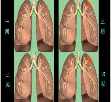 肺癌的分期你了解吗？