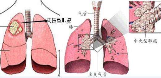 如何区分中央型肺癌和周围型肺癌