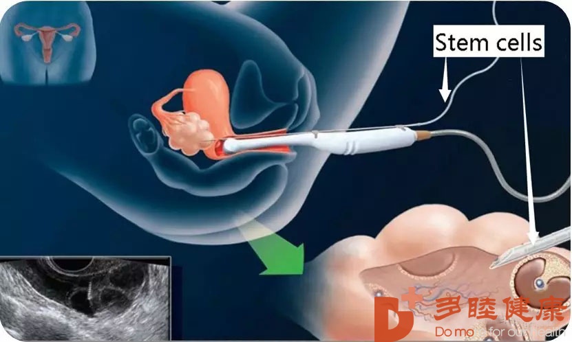 日本干细胞-三十岁以后卵巢保养不可忽视！干细胞助力卵巢健康