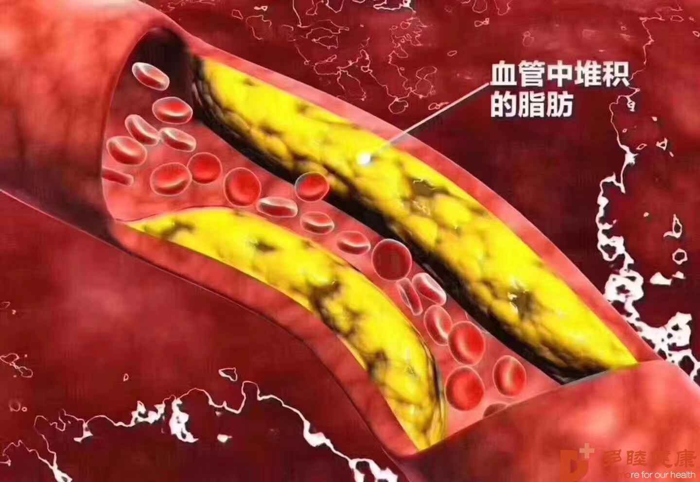 日本血液净化-超过40一定要注意血管健康，血液净化让血管不再堵塞