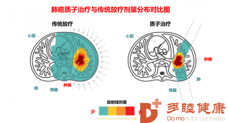 日本医疗-质子治疗有精准向肿瘤的能力 肺癌必选