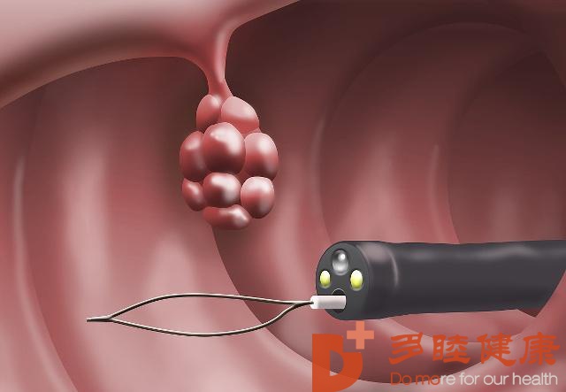 日本体检-息肉、肿块会癌变吗？体检发现这几个地方要尽快切除！