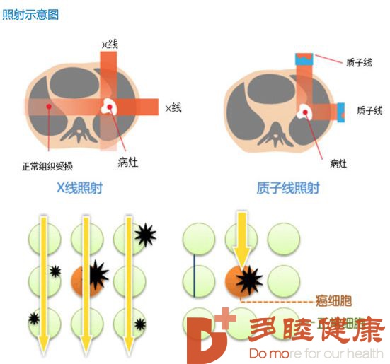 日本医疗-质子射线精准爆破肿瘤副作用少